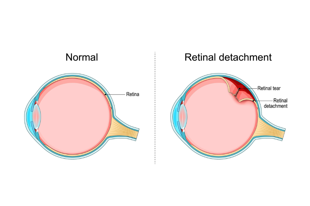 Αποκόλληση Αμφιβληστροειδούς